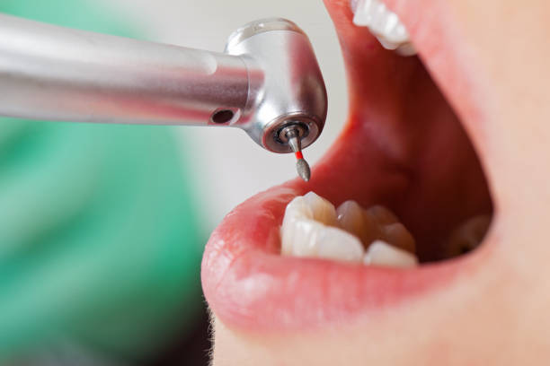 Best Emergency Dentist for Knocked-Out Tooth in Calverton Park, MO